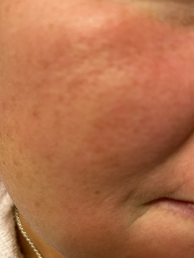 May is Lupus and Lyme Awareness Month!!! – the autoimmune professor
